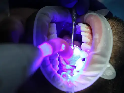 Wybielanie zębów: skuteczne metody na długotrwały efekt