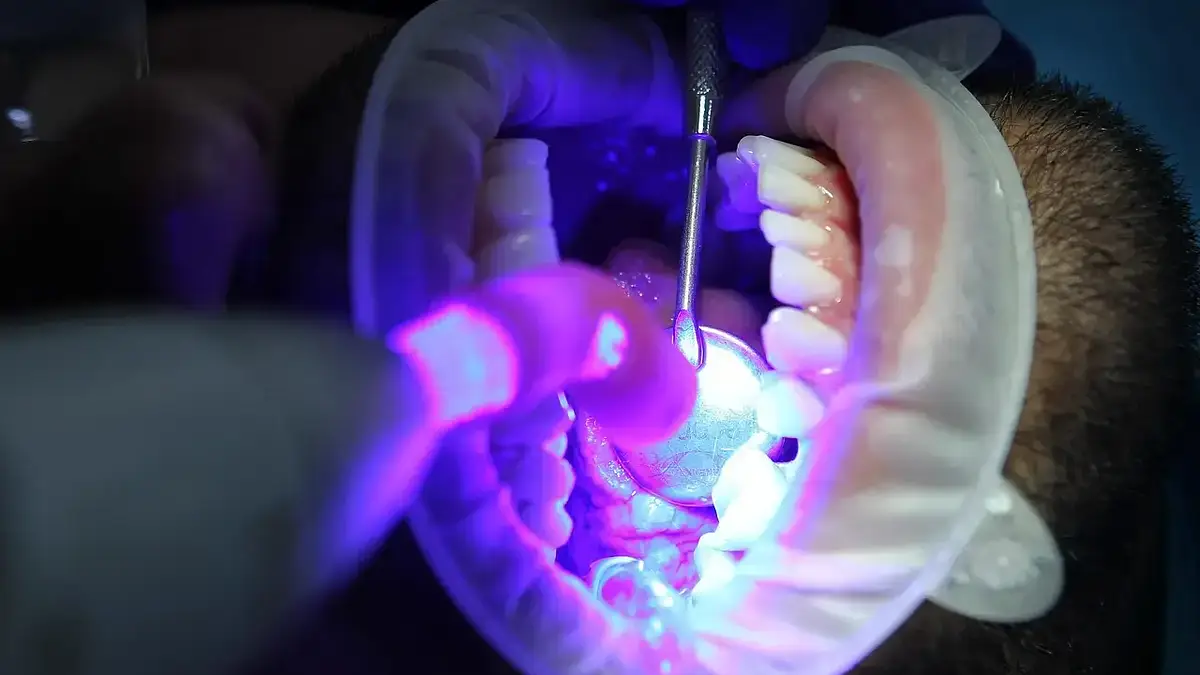 Wybielanie zębów: skuteczne metody na długotrwały efekt